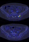 Non-Hodgkin lymphoma, CT-PET scan