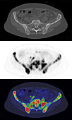 Pelvic bone metastases from breast cancer, CT and PET scans
