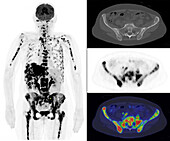 Metastatic breast cancer, PET and CT scans