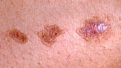Porokeratosis of Mibelli lesions