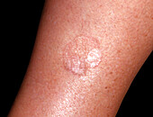 Porokeratosis of Mibelli lesions