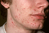Acne vulgaris on a man's face
