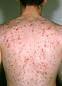 Acne vulgaris on a man's back
