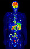 Hodgkin lymphoma, PET scan