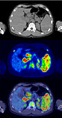 Hodgkin lymphoma, CT and PET scans