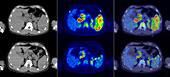 Hodgkin lymphoma recurrence, CT and PET scans
