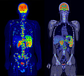Hodgkin lymphoma, PET and CT-PET scans