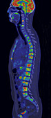 Hodgkin lymphoma, CT-PET scan