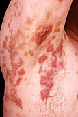 Secondary syphilis rash on a man's armpit