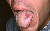 Erythema multiforme on a man's tongue