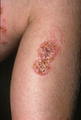 Bullous impetigo on a girl's arm