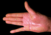 Keratoderma on a man's palm