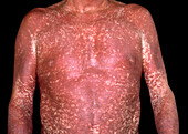 Skin lesions due to mastocytosis on a man's v