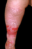 Pretibial myxoedema on a woman's leg