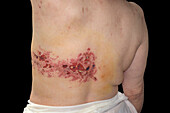 Shingles rash on a woman's back