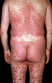 Plaque psoriasis on a man's back and legs