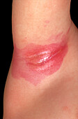 Inverse psoriasis on a child's armpit