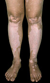 Vitiligo on a woman's lower limbs