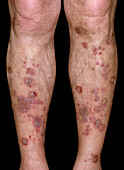 Lichen planus on a man's lower legs