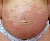 Gestational bullous pemphigoid on a woman's abdomen