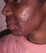 Acne vulgaris