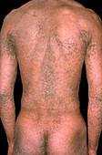 Congenital ichthyosiform erythroderma