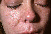Skin lesions in tuberous sclerosis