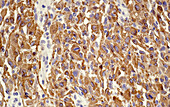 Glioblastoma, light micrograph