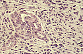 Glioblastoma, light micrograph