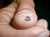 Small blood blister