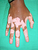 Vitiligo in Addison's disease