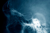 Pituitary gland cancer, X-ray