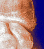 De Quervain's syndrome, X-ray