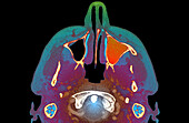 Infected maxillary sinus, CT scan