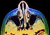 Maxillary sinuses, CT scan