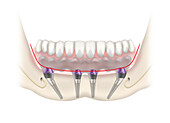 Lower jaw prosthesis with implants, illustration