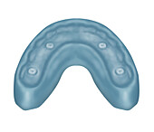 Dental putty mould, illustration