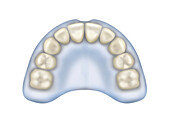 Upper jaw denture, illustration