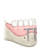 Bar-supported prosthesis on resorbed mandible, illustration