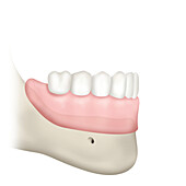 Prosthesis on slightly resorbed mandible, illustration