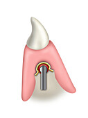 Lower jaw tooth with bar-supported prosthesis, illustration