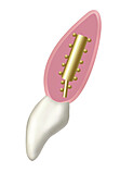 Hybrid dental implant showing gold bar with ceramic crown, illustration