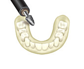 Wax try-in prosthesis with conical bur, illustration