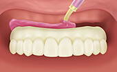 Wax try-in prosthesis in mouth with acrylic being added, illustration