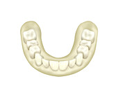 Wax try-in dental prosthesis with analogues, illustration