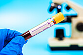 Liver cancer marker blood test