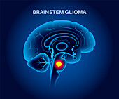 Brainstem glioma, illustration