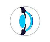Orthokeratology contact lens, illustration