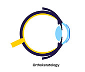Orthokeratology contact lens, illustration
