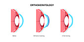Orthokeratology contact lens, illustration